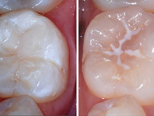 Clontarf Dental Practice - Fissure Sealants